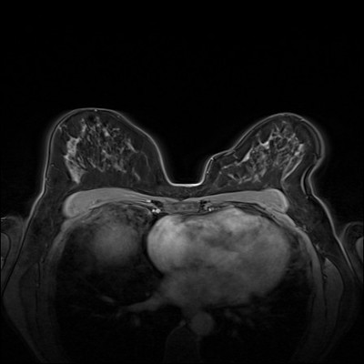 Carcinome canalaire in situ supéro-médian droit Dynamique FS 1 min