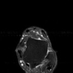 tendinopathie fissuraire du court fibulaire avec kyste intra tendineux. Axial DP fat sat tendinopathie fissuraire du court fibulaire avec kyste intra tendineux. Axial DP fat sat