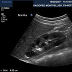 Duplicité rénale gauche avec urétérocèle obstructif sur le pyélon supérieur et reflux vésico-rénal sur le pyélon inférieur Echographie rénale Duplicité rénale gauche avec urétérocèle obstructif sur le pyélon supérieur et reflux vésico-rénal sur le pyélon inférieur Echographie rénale