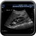 Duplicité rénale gauche avec urétérocèle obstructif sur le pyélon supérieur et reflux vésico-rénal sur le pyélon inférieur  Echographie rénale