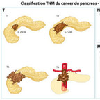Cancer du pancreas classification-tnm-cancer-du-pancreas Cancer du pancreas classification-tnm-cancer-du-pancreas