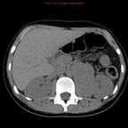 Paragangliome TDM Abdomen Axial Sans injection Paragangliome TDM Abdomen Axial Sans injection