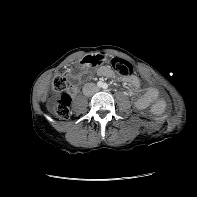 Traumatic perforation of small intestine, fracture of lumbar vertebra Abdomen CT,  Portal venous phase, Axial plane