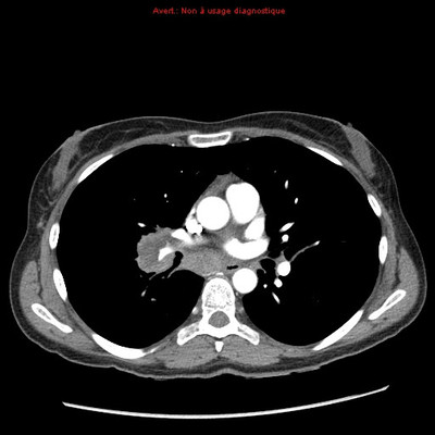 Adénocarcinome pulmonaire avec contingent à cellules claires TDM Thorax Axial Fenêtre Tissus mous