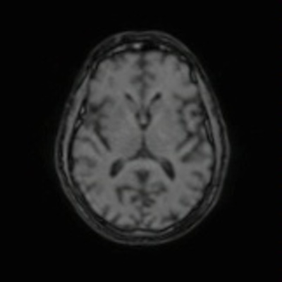 Schwannome cochléovestibulaire (neurinome de l'acoustique) AAHScout_MPR_tra