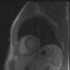 Infarctus du myocarde localisé au ventricule droit Perfusion de premier passage en petit axe Infarctus du myocarde localisé au ventricule droit Perfusion de premier passage en petit axe