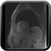 Infarctus du myocarde localisé au ventricule droit Perfusion de premier passage en petit axe