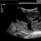 Tumeur de la granulosa. Echographie Pelvis Tumeur de la granulosa. Echographie Pelvis
