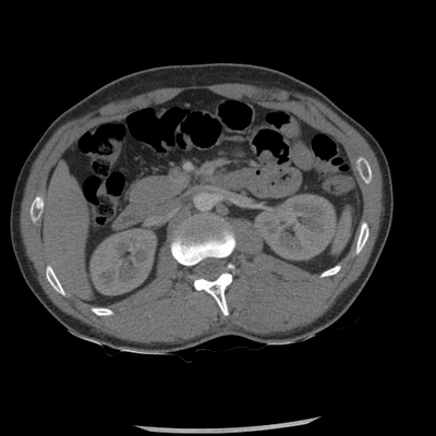 Thoracic Injuries, Spinal Injuries L5, Traumatic disc herniation Chest, Abdomen and Pelvis, Arterial phase, Axial plane