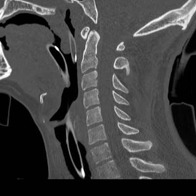 Traumatic diaphragmatic rupture, Thoracic and abdominal injuries, burst vertebral fracture, foot injuries Cervical spine, Sagittal plane, Bone window