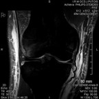 Rupture du LCA et du ligament collatéral médial FRONTAL DP FAT SAT Rupture du LCA et du ligament collatéral médial FRONTAL DP FAT SAT