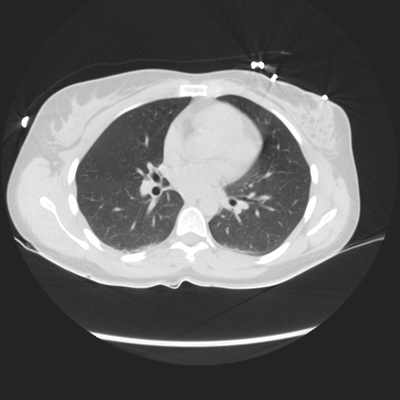 Abdominal vessels trauma, Intraperitoneal bladder rupture, Spleen infarction, Pelvic fracture Chest CT, Lung window, Axial plane