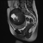Nécrobiose hémorragique d'un fibrome utérin interstitiel Sagittal T2 Nécrobiose hémorragique d'un fibrome utérin interstitiel Sagittal T2