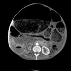 Fecalome géant TDM Abdomen Axial Temps veineux Fecalome géant TDM Abdomen Axial Temps veineux