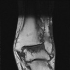 ostéite du talus sur arthrite septique coronal T1 ostéite du talus sur arthrite septique coronal T1