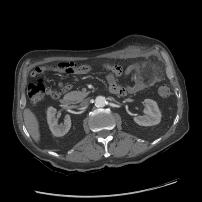 Injury of abdominal wall, Acute hemorrhage Chest, Abdomen and Pelvis, Arterial phase, Axial plane