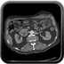 Injury of abdominal wall, Acute hemorrhage Chest, Abdomen and Pelvis, Arterial phase, Axial plane