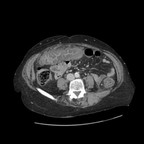 Colite infectieuse Axial Colite infectieuse Axial
