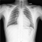 Pneumomédiastin par rupture alvéolaire (effet Macklin) Radiographie Thorax Pneumomédiastin par rupture alvéolaire (effet Macklin) Radiographie Thorax