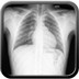Pneumomédiastin par rupture alvéolaire (effet Macklin)  Radiographie Thorax