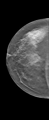 Asymétrie mammaire avec petit nodule dont l’aspect est en faveur d’un fibroadénome au sein d'un tissu glandulaire plus dense à droite. RCC Tomosynthèse