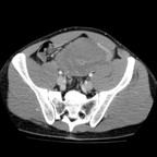 Tumeur desmoide mésentérique ou fibrome diffus envahissant du mésentère. TDM Abdomen Axial Temps veineux Tumeur desmoide mésentérique ou fibrome diffus envahissant du mésentère. TDM Abdomen Axial Temps veineux