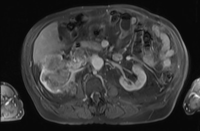 Adénocarcinome rénal droit avec envahissement de la veine rénale et de la VCI Portal post Gadolinium