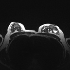 Carcinome canalaire infiltrant du sein SBRII Axial T2 Carcinome canalaire infiltrant du sein SBRII Axial T2