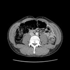 Thrombose d'une veine hépatique drainant le segment VI. TDM Abdomen Pelvis Axial Temps veineux Thrombose d'une veine hépatique drainant le segment VI. TDM Abdomen Pelvis Axial Temps veineux
