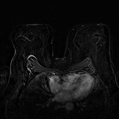Doute sur une distorsion architecturale du QSE droit, correspondant à des superpositions en tomosynthèse. Soustraction 3 min