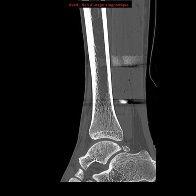 Plaies des parties molles de la cheville par arme à feu  TDM Membre inférieur Sagittal