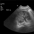 tératome sacro coccygien Echographie Pelvis Abdomen tératome sacro coccygien Echographie Pelvis Abdomen