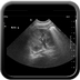 tératome sacro coccygien  Echographie Pelvis Abdomen