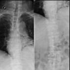 Fracture en H du sacrum par insuffisance osseuse Radiographie Rachis Fracture en H du sacrum par insuffisance osseuse Radiographie Rachis
