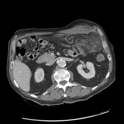 Injury of abdominal wall, Acute hemorrhage Abdomen CT, Portal venous phase, Axial plane