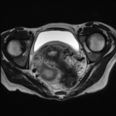 Rectal obstruction due to endometriosis Axial T2