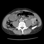 Liposarcome de type myxoide avec rupture hémorragique responsable d'un hémopéritoine. TDM Abdomen Axial Temps veineux Liposarcome de type myxoide avec rupture hémorragique responsable d'un hémopéritoine. TDM Abdomen Axial Temps veineux