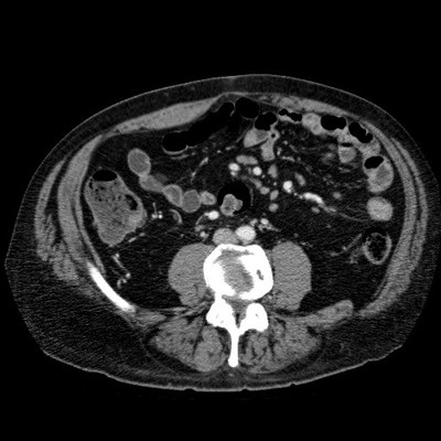 Epaississement jéjunal isolé en rapport avec une maladie de Crohn.  TDM Abdomen Axial Temps veineux