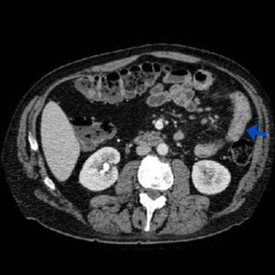 Epaississement jéjunal isolé en rapport avec une maladie de Crohn.  TDM Abdomen Axial Temps veineux