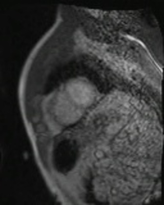 Dysplasie arythmogène du ventriule droit (DAVD) : critère majeur en IRM PERFUSION RespLib _dynamic_rest_MOCO
