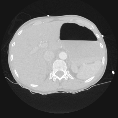 Traumatic perforation of small intestine, fracture of lumbar vertebra Chest, Abdomen and Pelvis, Lung window