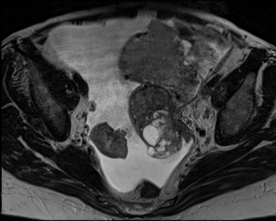 Cystadénocarcinome ovarien séro-papillaire moyennement différencié Stade IIIb Axial T2