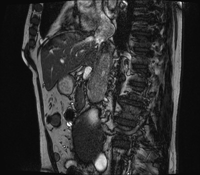 Adénocarcinome rénal droit avec envahissement de la veine rénale et de la VCI Sagittal TrueFISP