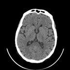 Thrombus du tronc basilaire sans injection Thrombus du tronc basilaire sans injection