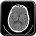 Thrombus du tronc basilaire sans injection