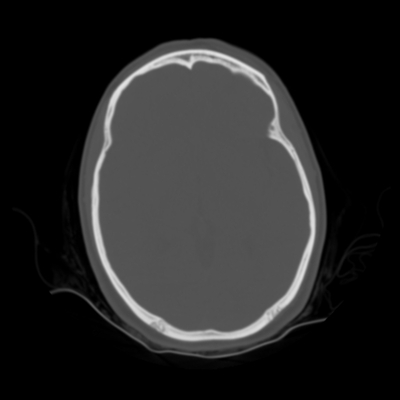 Abdominal vessels trauma, Intraperitoneal bladder rupture, Spleen infarction, Pelvic fracture Head CT, Axial plane, Bone window