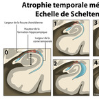Atrophie hippocampique (Scheltens) Classification de Scheltens - Schéma Atrophie hippocampique (Scheltens) Classification de Scheltens - Schéma