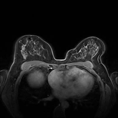 Carcinome canalaire in situ supéro-médian droit Dynamique FS 4 min