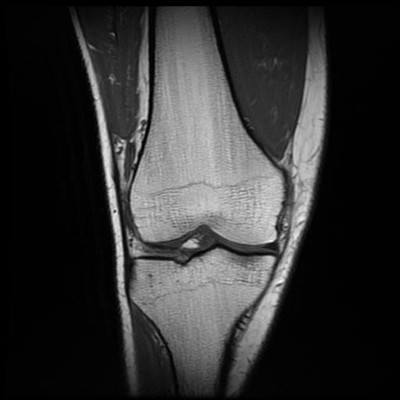 bipartite patella  MRI Lower limb Coronal T1w