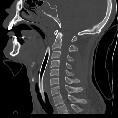 Cranioencephalic injuries, limb injuries, aspiration pneumonia Cervical spine, Sagittal plane, Bone window
